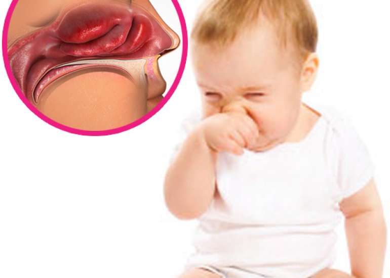 Nasal congestion and mouth breathing. What could it mean?